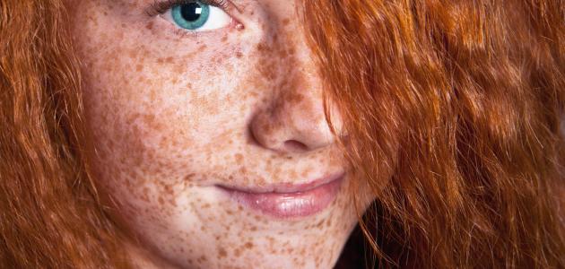 ما هو النمش