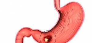 ما هي أعراض عصب المعدة