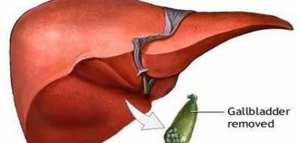 أعراض ما بعد استئصال المرارة