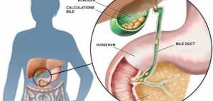 ما علاج حصوة المرارة