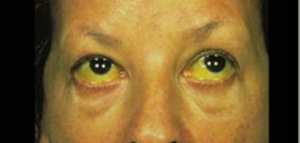 ما هو الركود الصفراوي