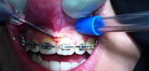 ما هو تجريف اللثة