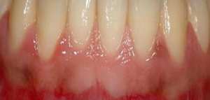 ما علاج التهاب اللثة