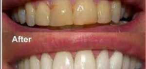 كيف أزيل الجير من الأسنان