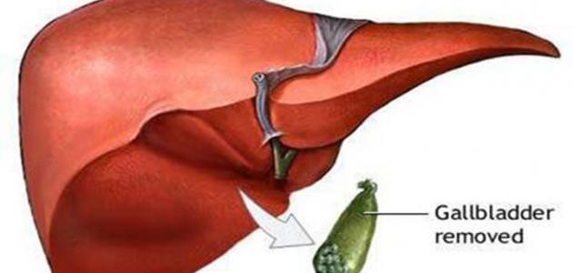 أعراض ما بعد استئصال المرارة