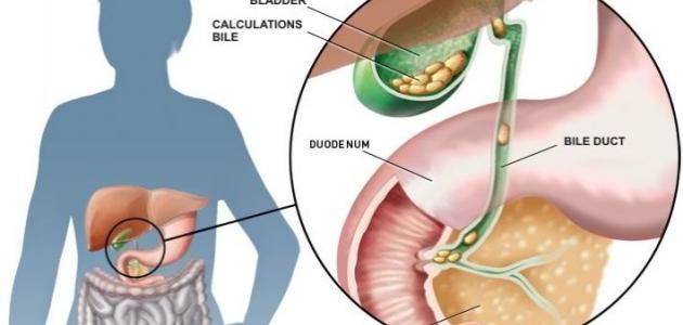 ما علاج حصوة المرارة