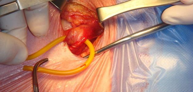 ما هي عملية الفتاق