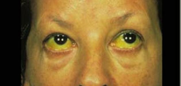 ما هو الركود الصفراوي