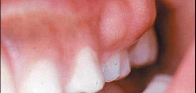 علاج خراج الاسنان