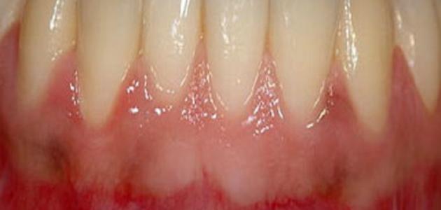 ما علاج التهاب اللثة