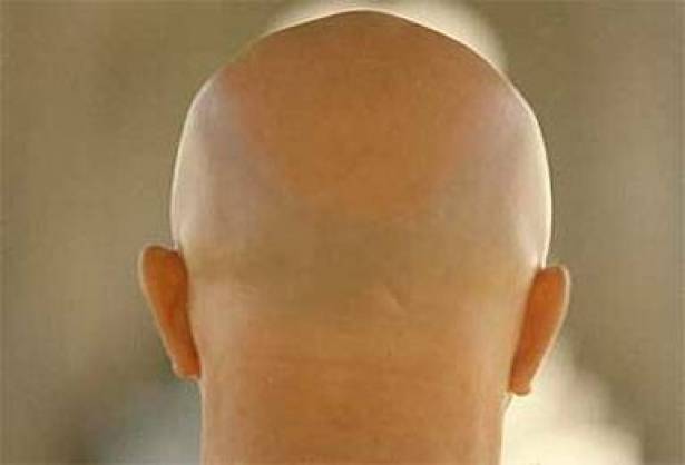 الرجال البيض قصيرو القامة... أنتم معرّضون للصلع اكثر من غيركم!