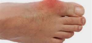 النقرس ومشاكل الكلى