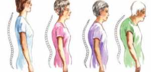 كيف تحمي نفسك من هشاشة العظام