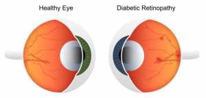 اعتلال الشبكية