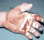 يحرقان شابا تدخل لإنقاذ طفل من محاولة سرقة                                    أصيب بحروق من الدرجة الثالثة في سوق أهراس