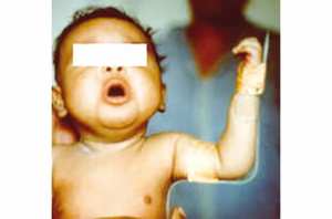 Traitement par injection de botox