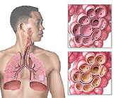 Grave affection infectueuse du poumon                                    Pneumonie