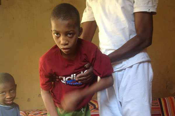 مرض غريب يصيب طفلين بتمنراست ويفقدهما الحركة كليا