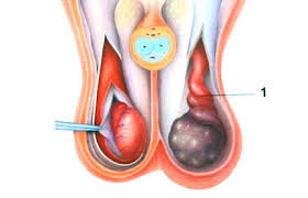 Douleur testiculaire chez l adolescent