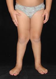 Jambes déformées !