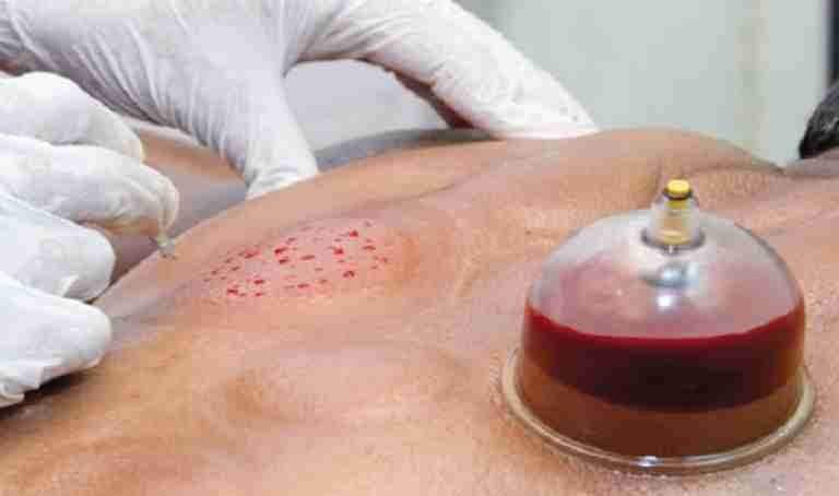 إقبال كبير على ممارسة الحجامة بالعاصمة