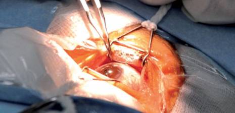 Panique dans les services de chirurgie ophtalmologique