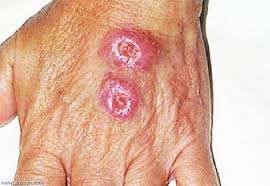 تراجع محسوس في حالات الإصابة بالليشمانيا الجلدية ببسكرة