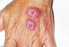 تراجع محسوس في حالات الإصابة بالليشمانيا الجلدية ببسكرة