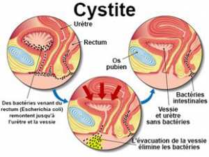 Infections urinaires (cystites)