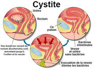 Infections urinaires (cystites)