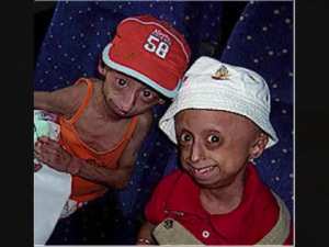 الشيخوخة المبكرة – متلازمة بروجيريا –