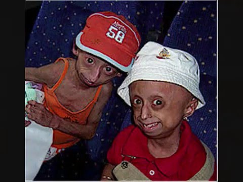 الشيخوخة المبكرة – متلازمة بروجيريا –