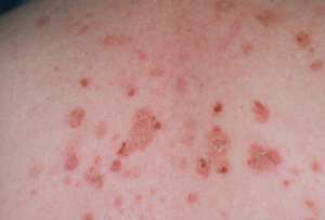 فقاع الأباعد الورمية (PNP):