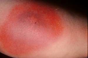 متلازمة البكتيريا آكلة اللحم