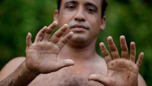 كثرة الأصابع