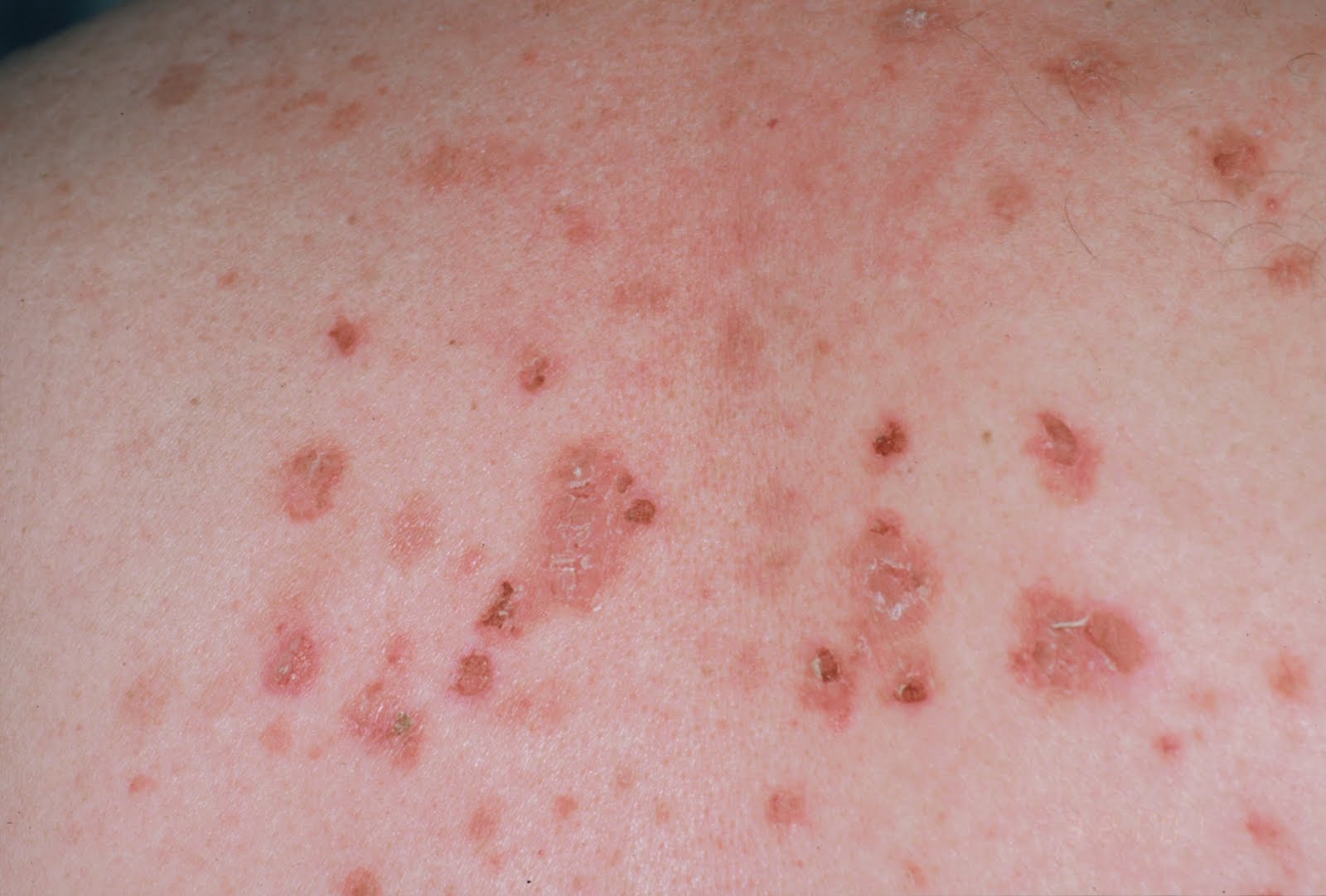 فقاع الأباعد الورمية (PNP):