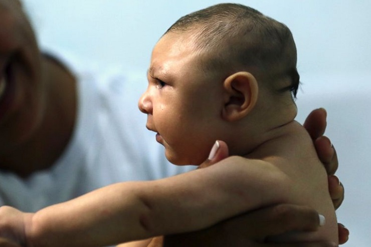 صغر الرأس (Microcephaly):