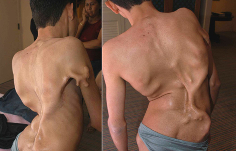 خلل التنسج الليفي المعظم المترقي (FOP):