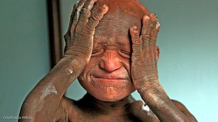 مرض التعظّم أو الجسم الحجري