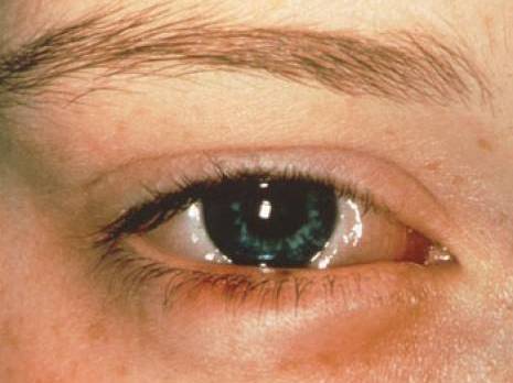 Santé : une épidémie de conjonctivite se profile                                    Oran : les autres articles