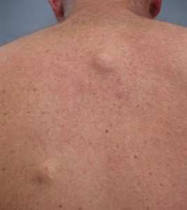 Nombreux kystes dermiques  asymptomatiques