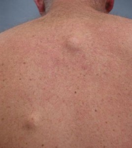 Nombreux kystes dermiques  asymptomatiques