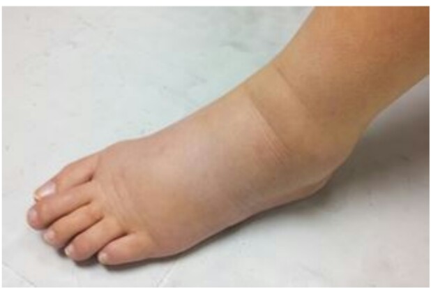 La rétention d'eau, qu'est-ce que c'est ?