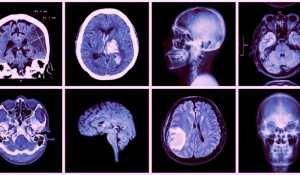 Tlemcen- Recrudescence des AVC : pression sur les services du CHU