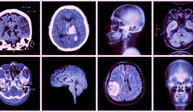 Tlemcen- Recrudescence des AVC : pression sur les services du CHU