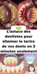 L’astuce des dentistes, éliminez le tartre de vos dents avec cette astuce maison !