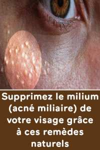 Supprimez le milium (acné miliaire) de votre visage grâce à ces remèdes naturels