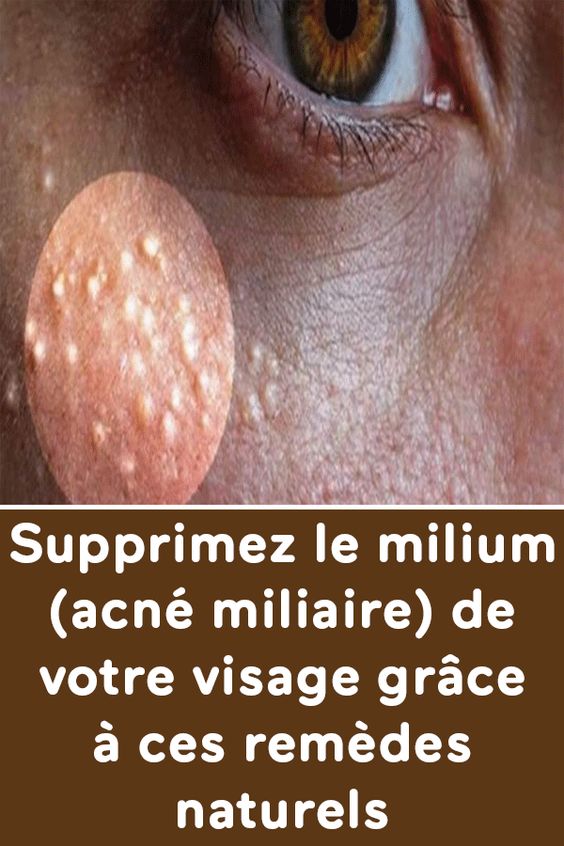 Supprimez le milium (acné miliaire) de votre visage grâce à ces remèdes naturels