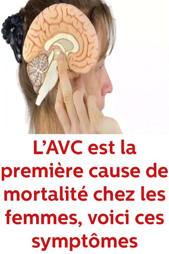 L’AVC est la première cause de mortalité chez les femmes, voici ces symptômes