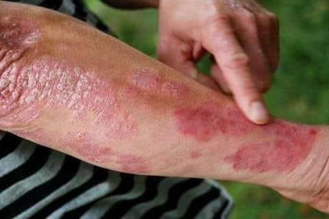 وصفة منزليه بسيطه جدا ومتوفرة في كل منزل وفعاله لعلاج الصدفية (Psoriasis)